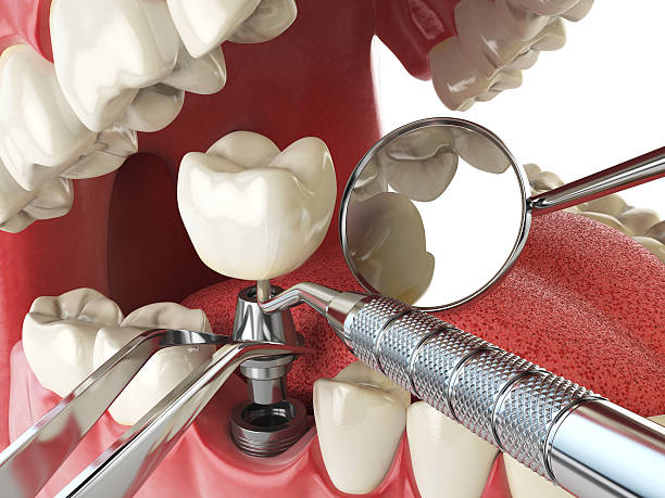 Best Emergency Dental Filling Replacement  in Hanahan, SC